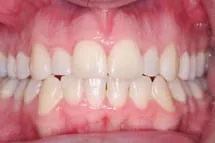 After Invisalign Plus Cosmetic Bonding 