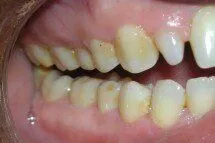 Ceramic (zirconia) Crowns