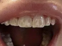 Icon whitespot treatment before