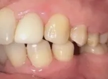 Left Ceramic Porcelain Crowns After