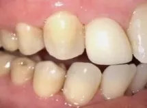 Ceramic Porcelain (zirconia) Crowns 