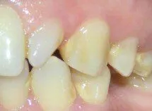 Left Ceramic Porcelain Crowns Before