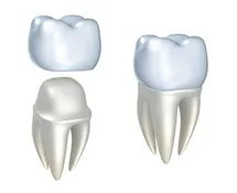 dental crowns Las Vegas NV dental crowns Las Vegas NV