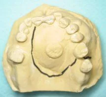 mouth mold