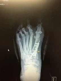 Bunion X-Ray After Surgery