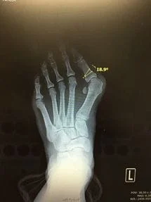 Bunion X-Ray Before Surgery