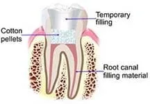 rootcanal-filling