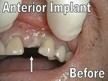 Before placement of single implant by Periodontist F Neal Pylant DMD
