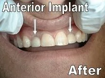 Two Single Implants After_F Neal Pylant_Periodontist_Athens Georgia