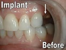 Single Implant Before_F Neal Pylant_Periodontist_Athens Georgia