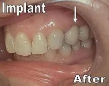 Single Implant After_F Neal Pylant_Periodontist_Athens Georgia