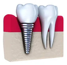 illustration of implant embedded in gum next to natural tooth, dental implants Washington DC dentist