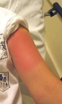 <strong>
</picture>Bee Sting of Upper Arm</strong> <p>This photo shows a localized reaction to a bee sting. There is mild redness in an oval 4 inches (10 cm) wide of the left upper arm. </p>