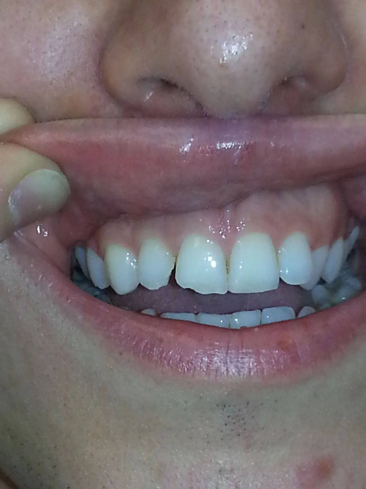 teeth before