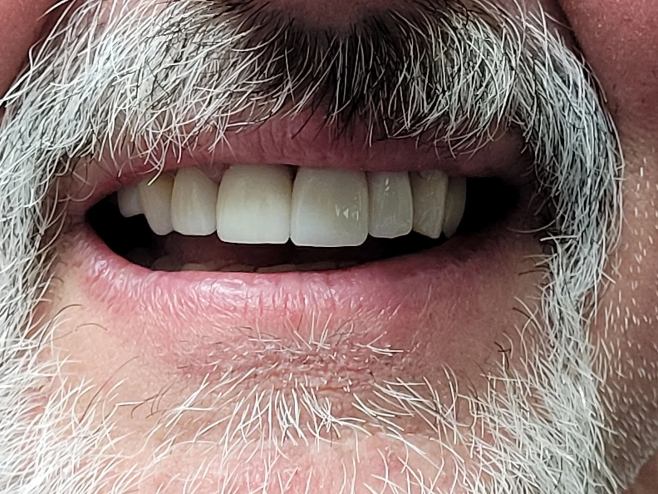 teeth after