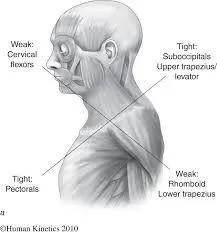 Upper Cross Syndrome