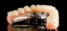 dental implant bridge cost