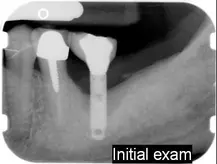 periimplantitis initial exam