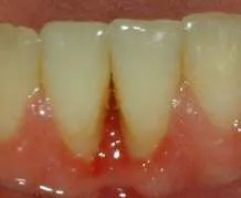 Pittsburgh periodontist picture of osteonecrosis of the jaw after treatment
