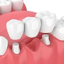 3 unit dental bridge being placed in mouth to replace tooth, dental bridge Novi, MI dentist