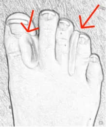 toe spacers