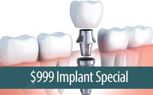 $999 Implant Special - Dental Implants Tracy CA