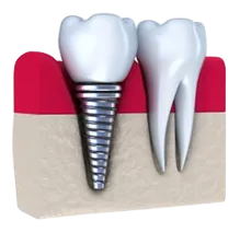illustration of dental implant embedded in gum tissue next to natural molar tooth, dental implants Philadelphia, PA cosmetic dentistry