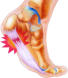 Plantar Fasciitis