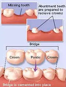 Dental Bridges Cedar Rapids, IA