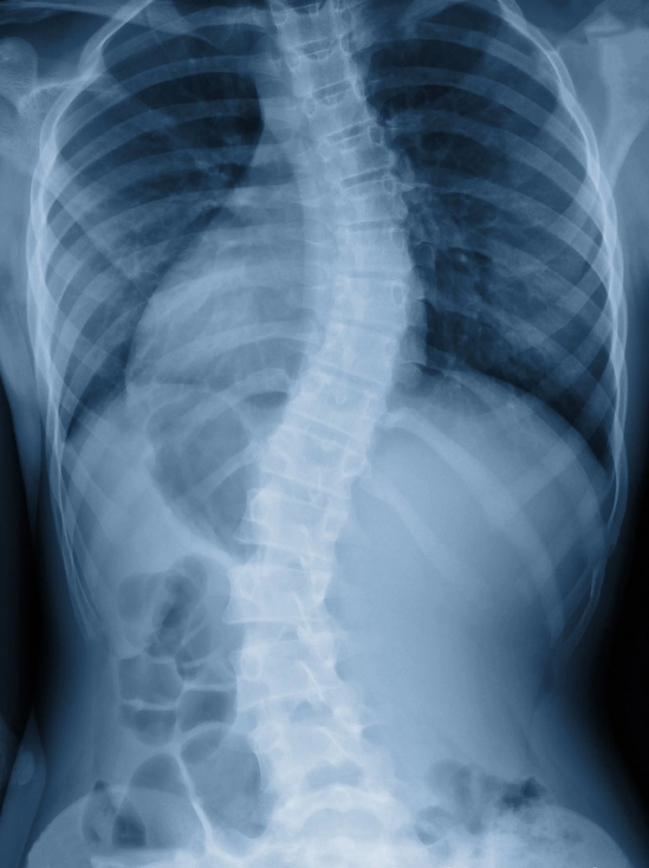 X-ray of scoliosis spine in Mississauga, ON