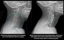 Cervical Spine X-ray DDD