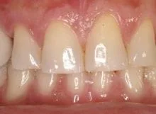 molar tooth implant