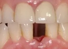 single tooth implant before and after