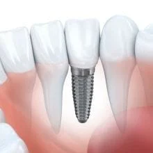 Dentures vs. Tooth Implants - What’s Best for You?