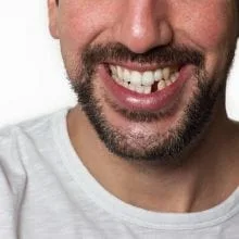 Top 5 Reasons to Replace Missing Teeth