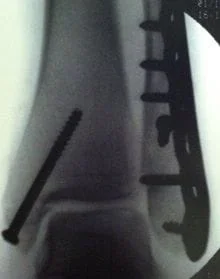 Post-OP Bimalleolar Ankle Fracture