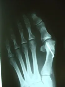 failed bunion surgery