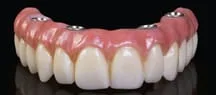 dental implant zirconia bridge
