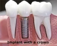 implant_crown_sm.jpg