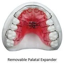 stony_brook_orthodontist_removable_palatal_expander