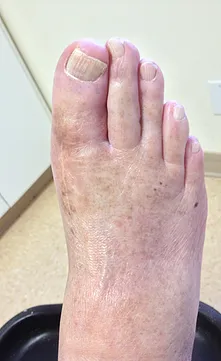 Stage 4 hallux rigidus with significant bone spur resection.