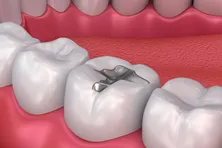 metal fillings