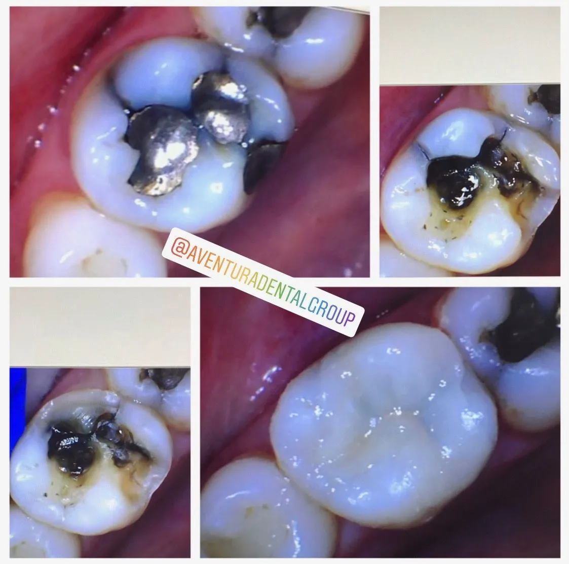 Holistic Amalgam Teeth Filling Removal and minimally invasive dental prep for onlay, only at Aventura Dental Group located at 20475 Biscayne Blvd., Aventura FL 33180.