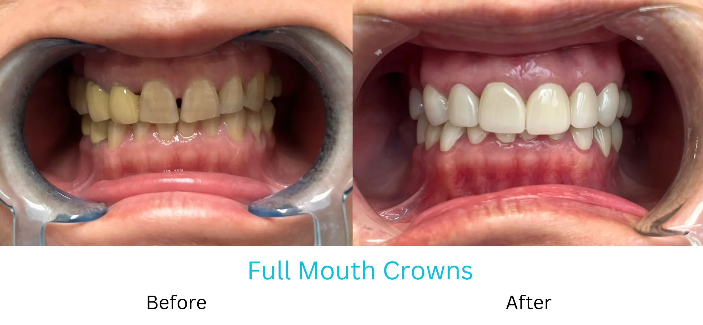 full mouth crowns