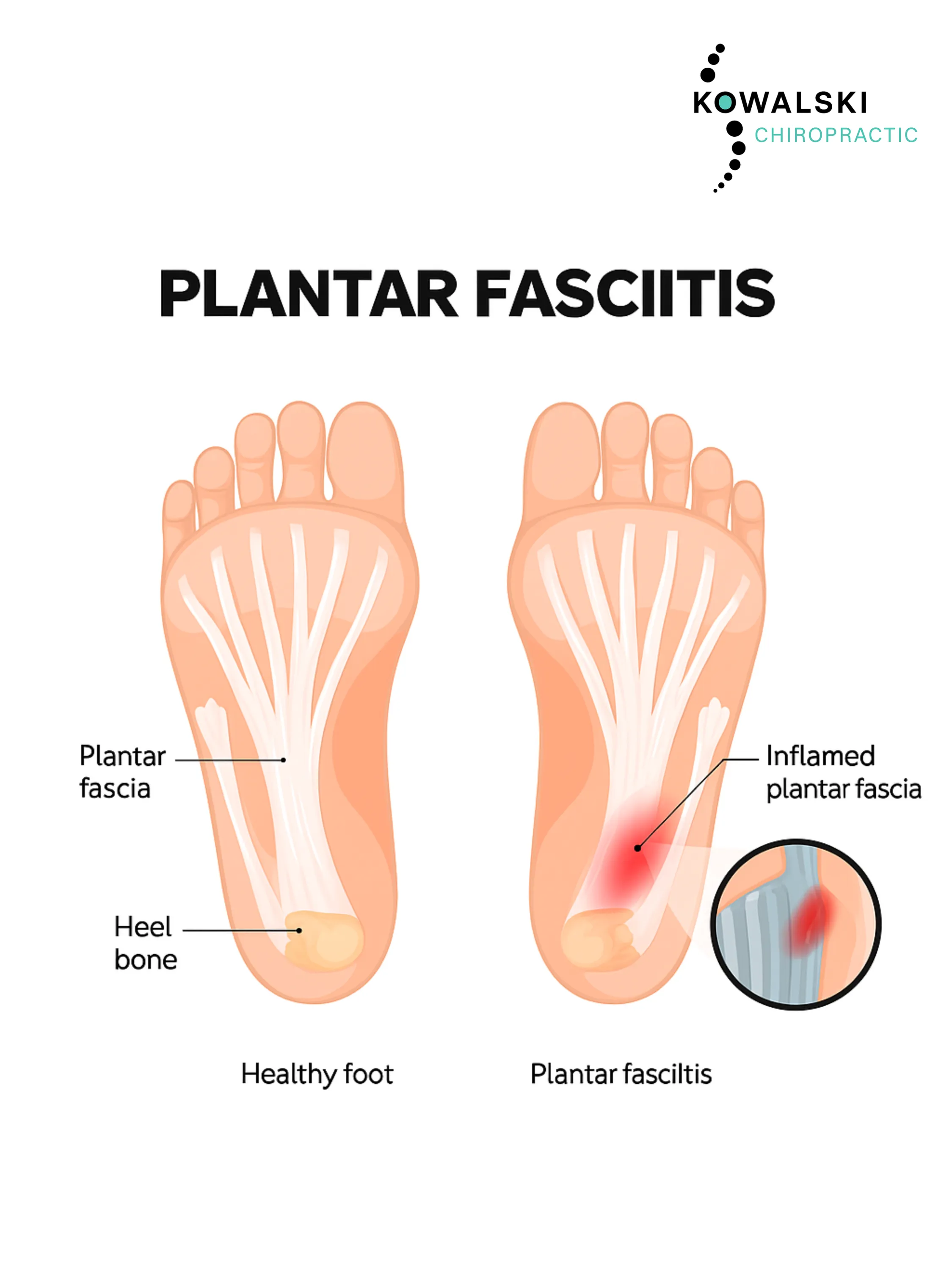 Plantar Fasciitis