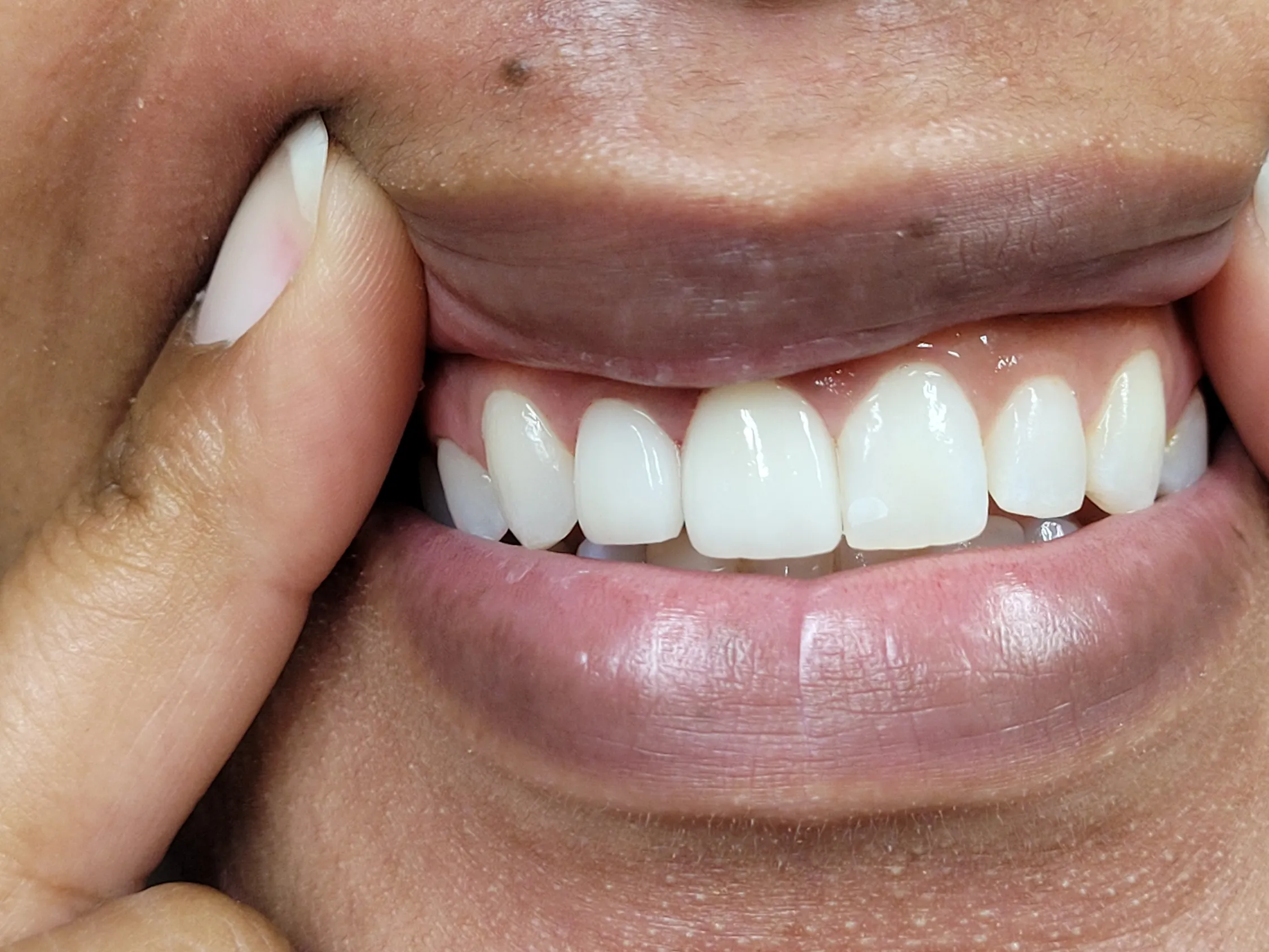 teeth after