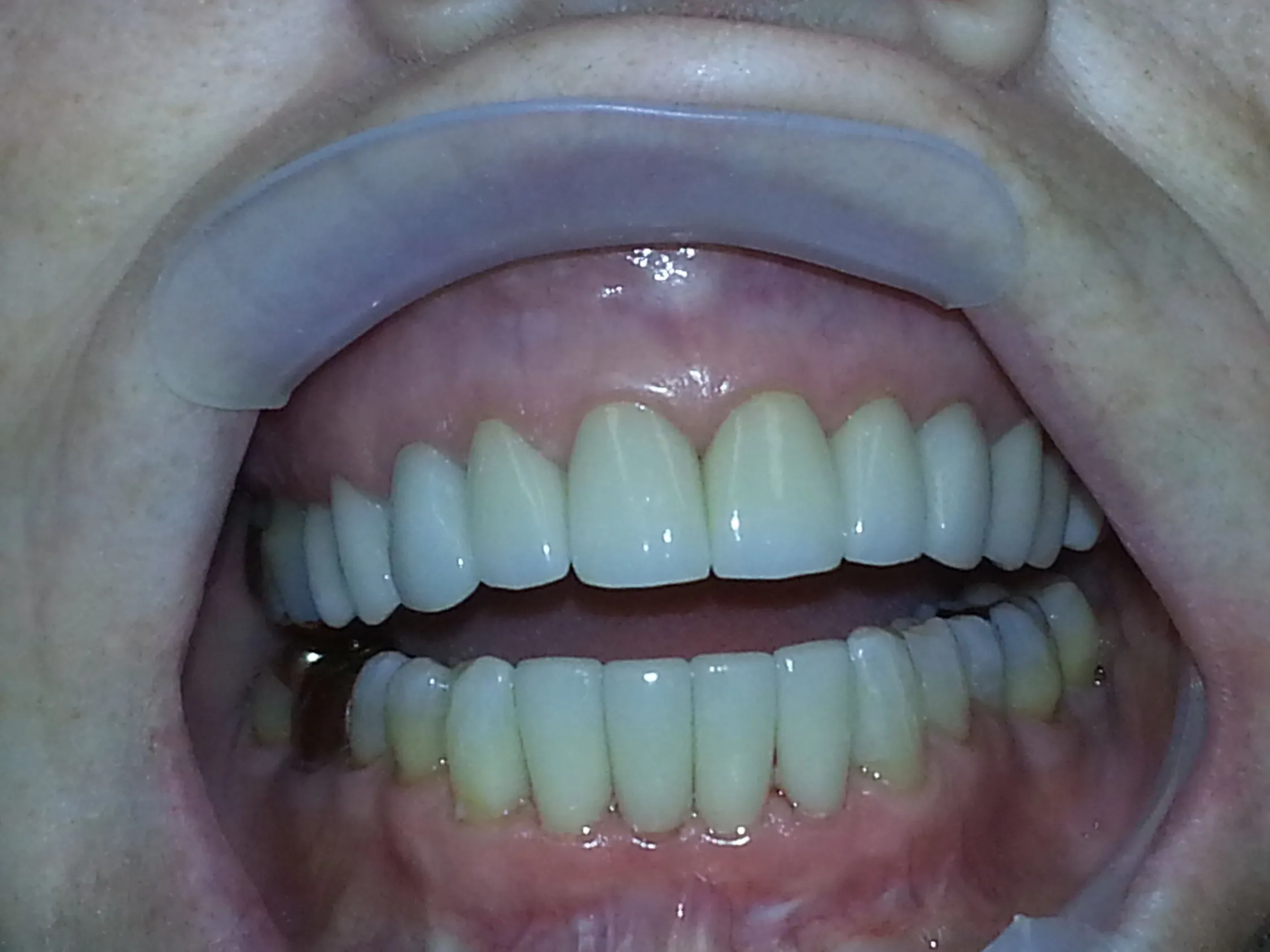 teeth after