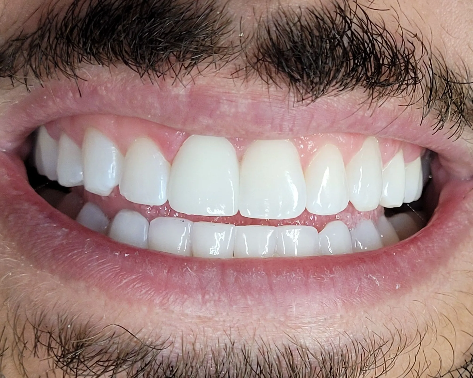 teeth after