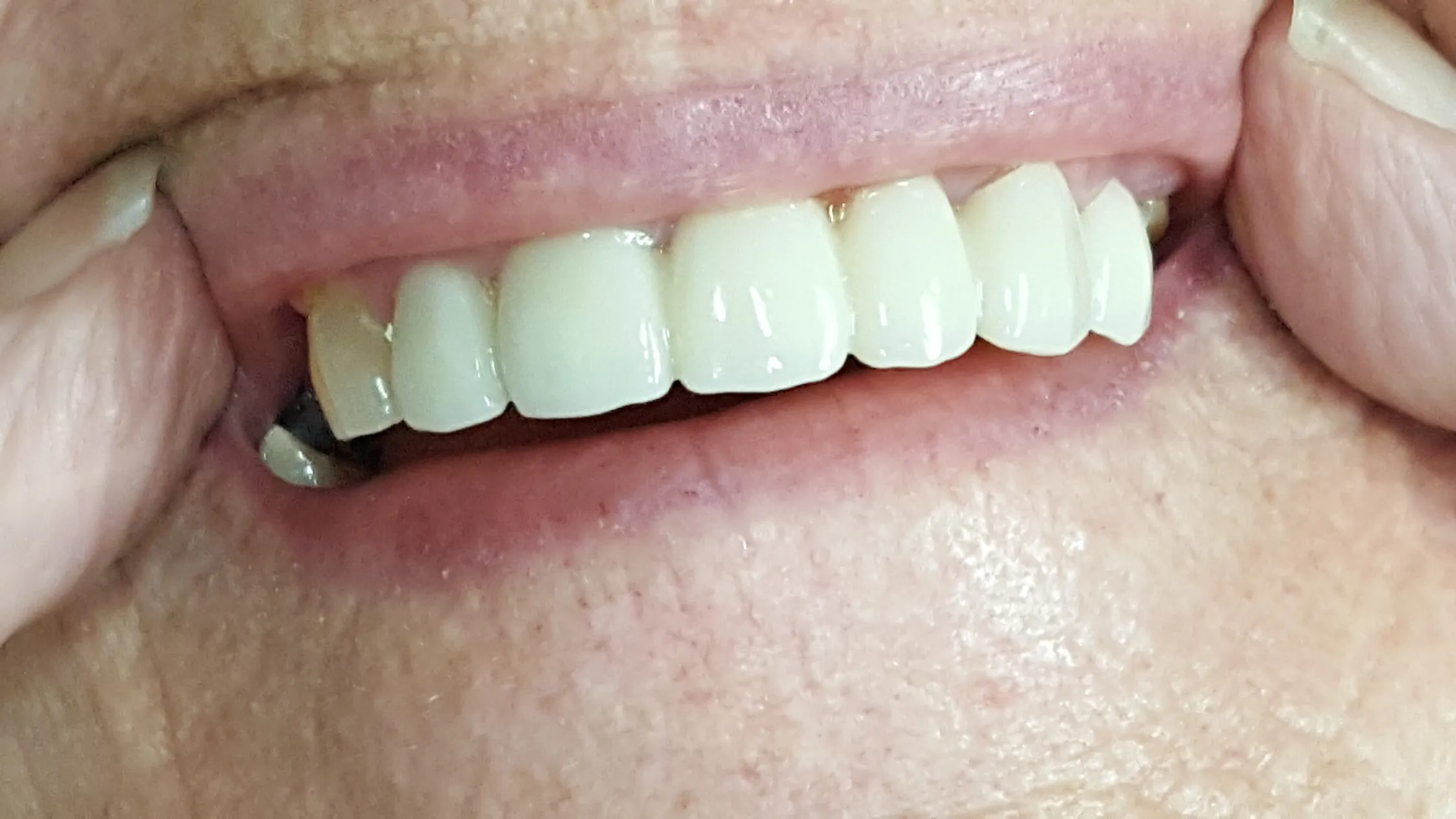 teeth_after