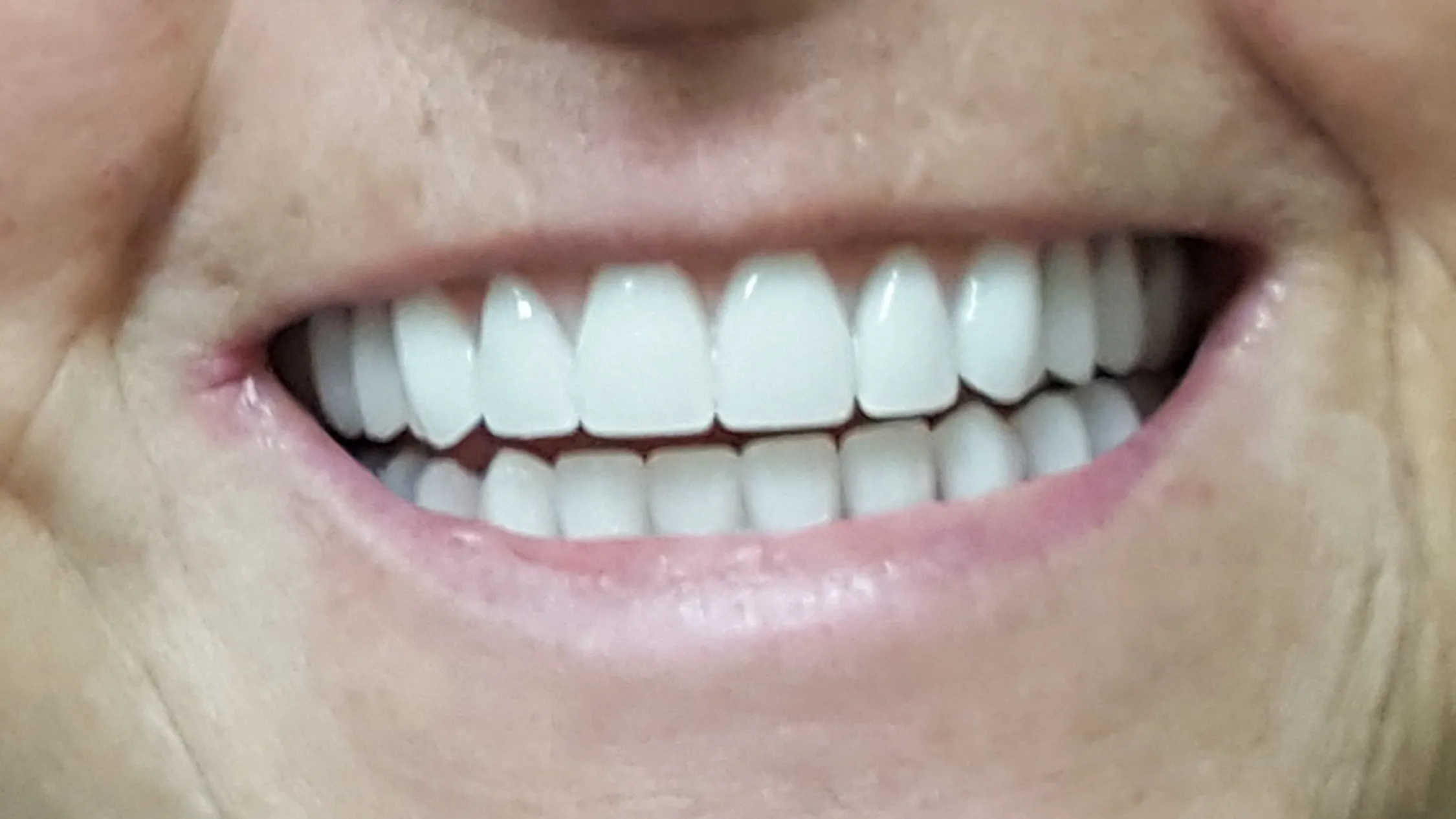 teeth after